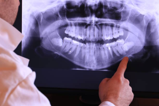Best Emergency Wisdom Tooth Extraction in Deer Park, WA