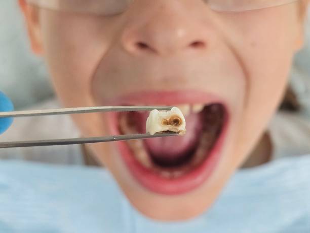 Best Broken or Chipped Tooth Repair in Deer Park, WA